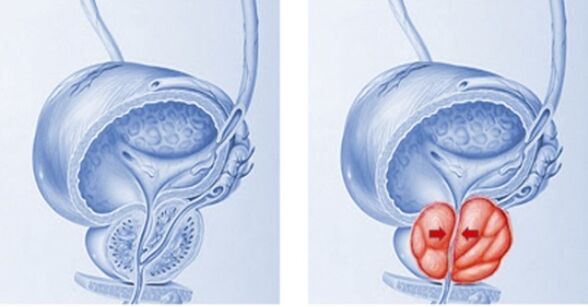 healthy and inflamed prostate with prostatitis